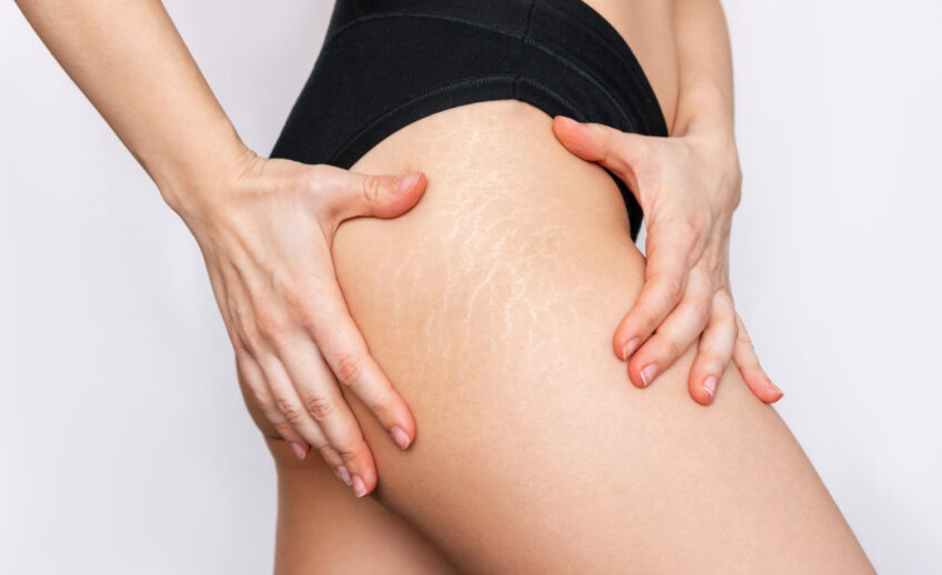 laserowe usuwanie rozstępów