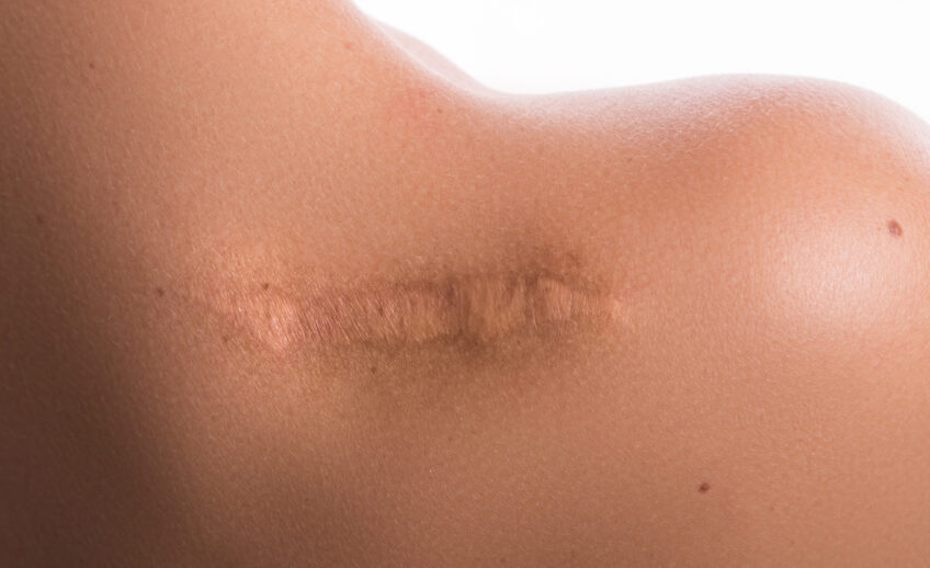 Usuwanie blizn atroficznych i keloidów